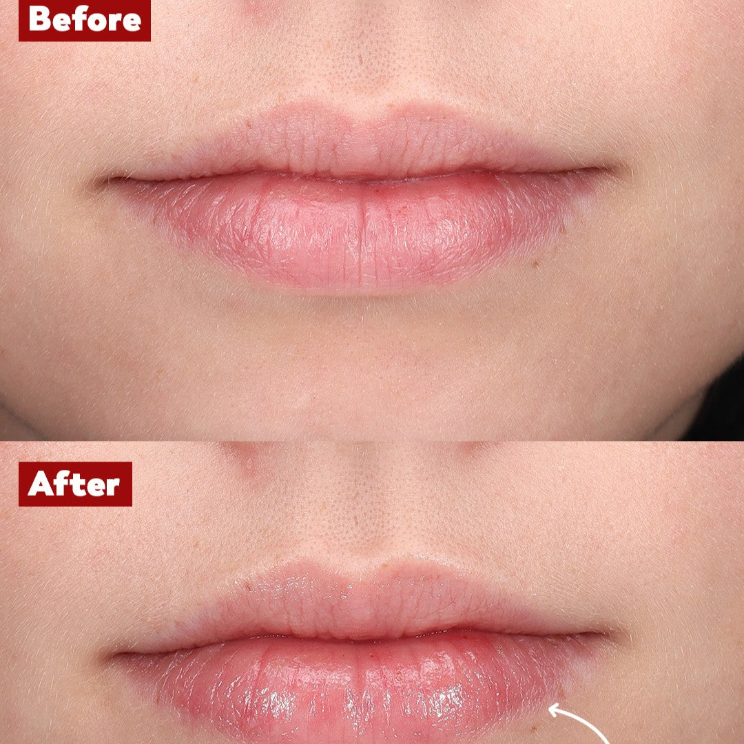 Plump Lip före & efter